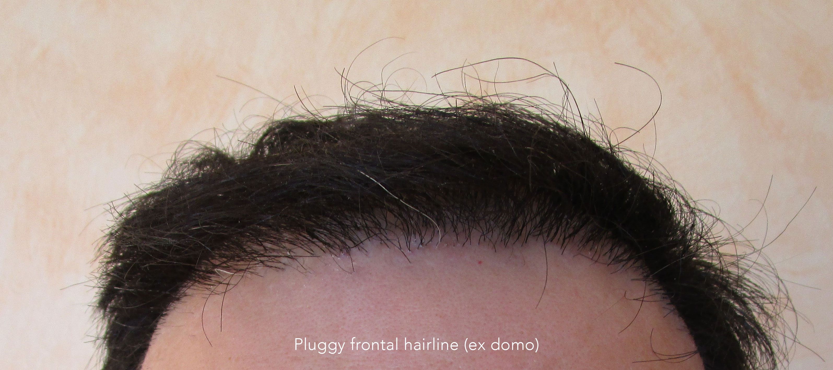 Preop1-hairline Results - Dr. Feriduni